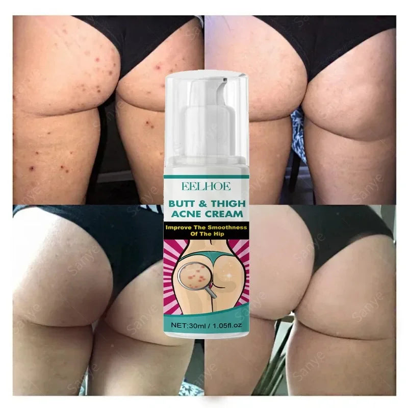 Inner Thigh Whitening Cream Butt Acne Treatment Serum Buttock Clearing Pimples Smooth Skin Care Fade Dark Spots Brighten Lotion