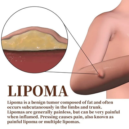 Lipoma Cream Subcutaneous Lumps Remover Treatment Medicine Liquid Apply To Skin Swelling Cellulite Fibroma Fat Mass Plaster