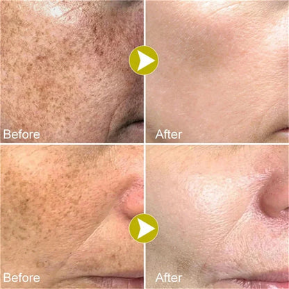 Whitening Freckle Cream Melasma Dark Spots Pigmentation Removal Products Fade Stain Melanin Repair Brighten Korean Skin Care