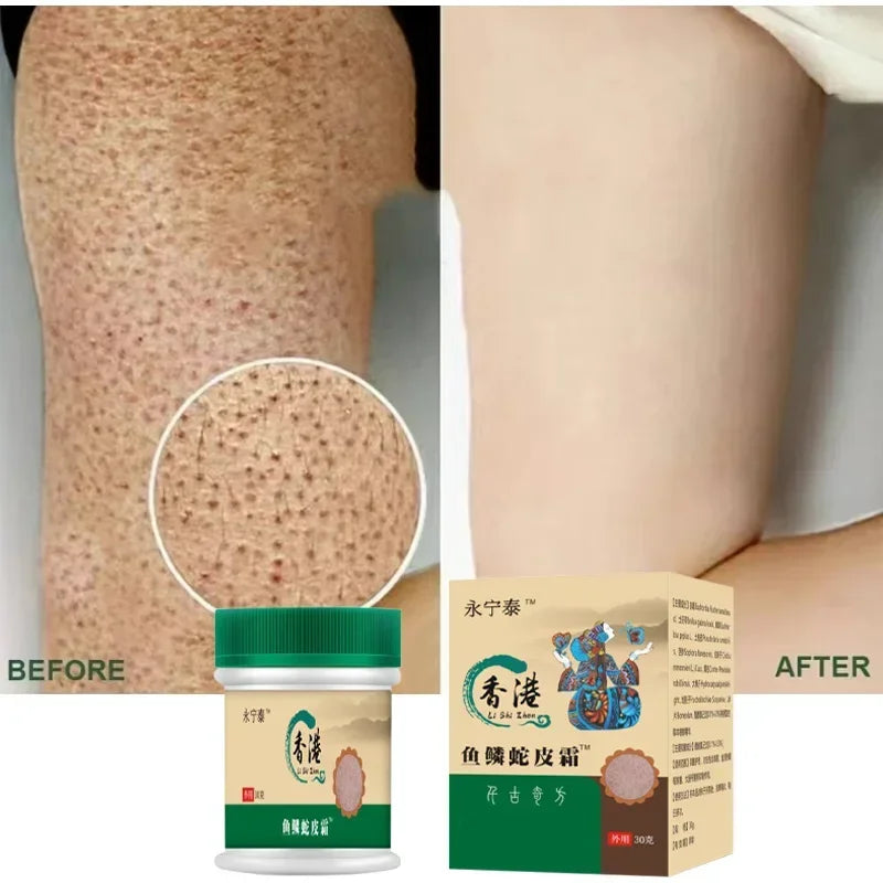 Chicken Skin Removal Treatment Body Scrub Cream Remove Dead Skin Cell Pore Spot Dull Whitening Moisturizing Body Care Cream