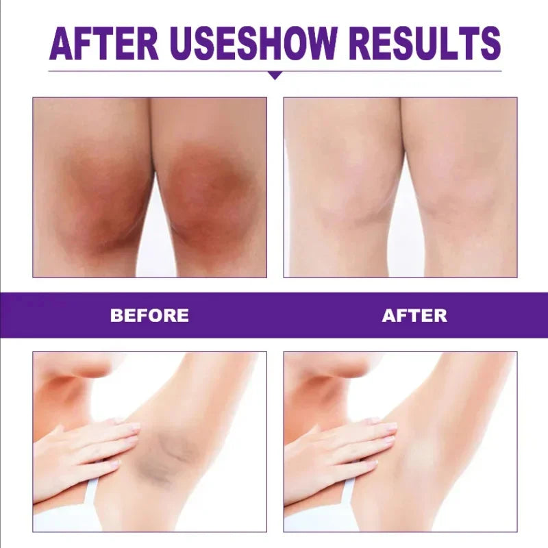 Brightening Cream For Intimate Parts Body Knees Remove Dull Pigments Brighten Serum Elbows Knuckles Lightening Skin Care Product