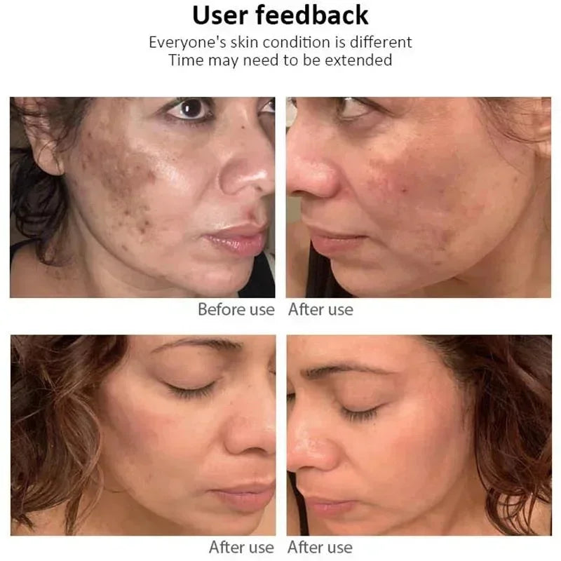 Effective Freckle Cream Fast Brighten Face Remove Melasma Dark Spot Fade Melanin Whiten Anti-pigmentation Improve Dullness Care