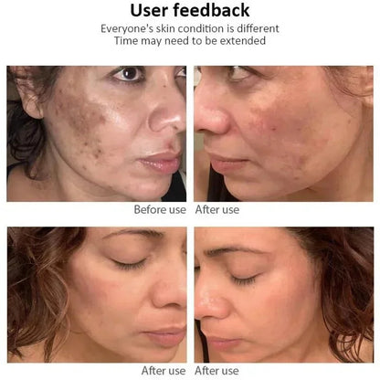 Effective Freckle Cream Fast Brighten Face Remove Melasma Dark Spot Fade Melanin Whiten Anti-pigmentation Improve Dullness Care