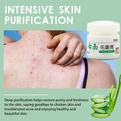 Body Acne Removal Cream Treatment Face Butt Back Acne Marks Smooth Repair Chicken Skin Cream Moisturizing Whitening Skin Care