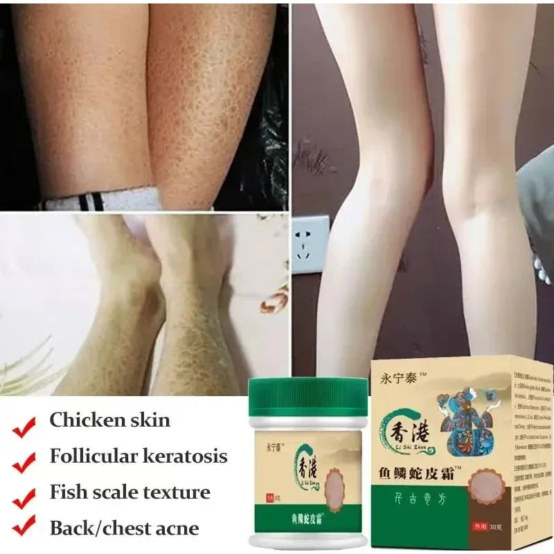 Chicken Skin Removal Treatment Body Scrub Cream Remove Dead Skin Cell Pore Spot Dull Whitening Moisturizing Body Care Cream