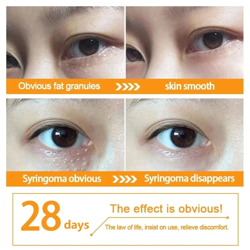 Fat Granules Remover Eye Cream Anti-Puffiness Anti Inflammatory Reduce Dark Circles Eyebags Fade Lines Moisturizing Eye Care