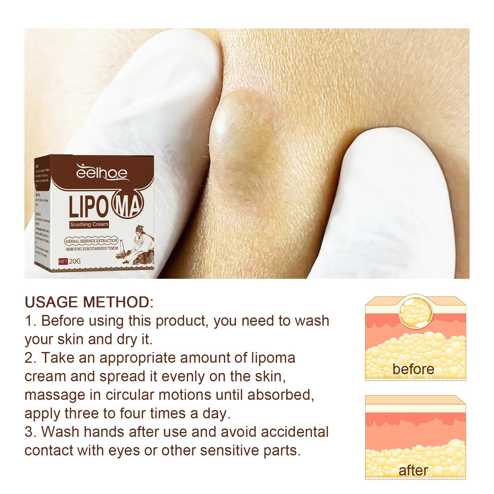 Lipoma Cream Subcutaneous Lumps Remover Treatment Medicine Liquid Apply To Skin Swelling Cellulite Fibroma Fat Mass Plaster