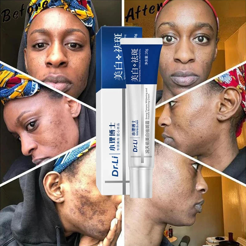 Effective Whitening Freckles Cream Remove Melasma Dark Spots Fade Pigmentation Moisturize Brighten Face Korean Skin Care Product