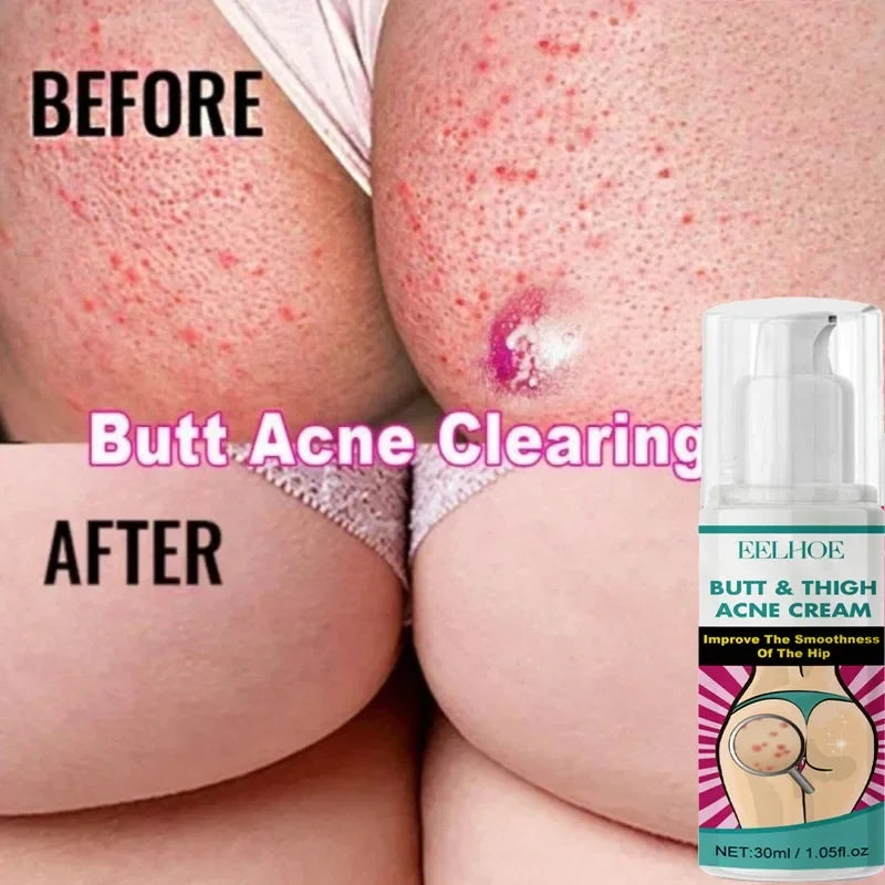 Inner Thigh Whitening Cream Butt Acne Treatment Serum Buttock Clearing Pimples Smooth Skin Care Fade Dark Spots Brighten Lotion