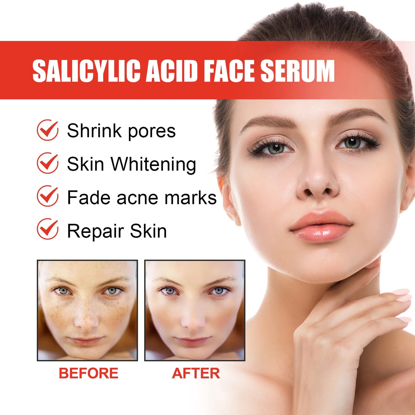 30ml Salicylic Acid Facial Serum Effectively Remove Melasma Lighten Dark Spots Acne Marks And Brighten Skin Tone