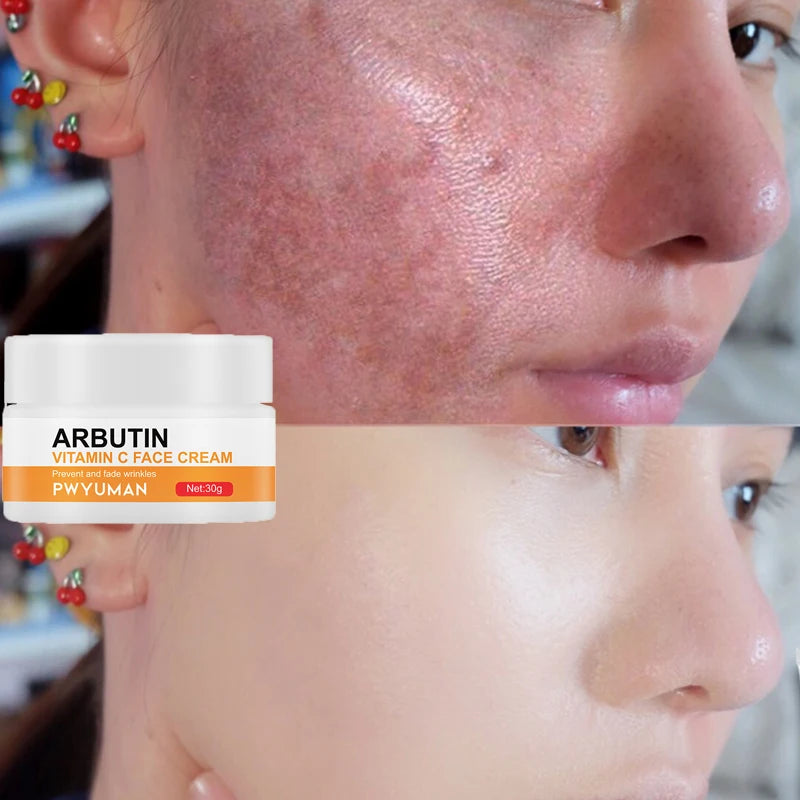 Powerful Whiten Freckle Cream Fast Remove Melasma Melanin Correcter Anti-Pigmentation Dark Spot Fade Improve Dullness Skin Care